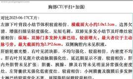 五次化免后多发淋巴结肿大，脑部新增病灶