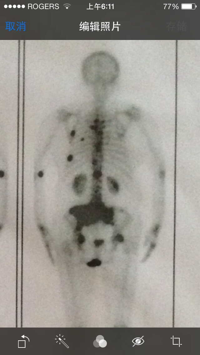 这是2014年11月的骨扫描