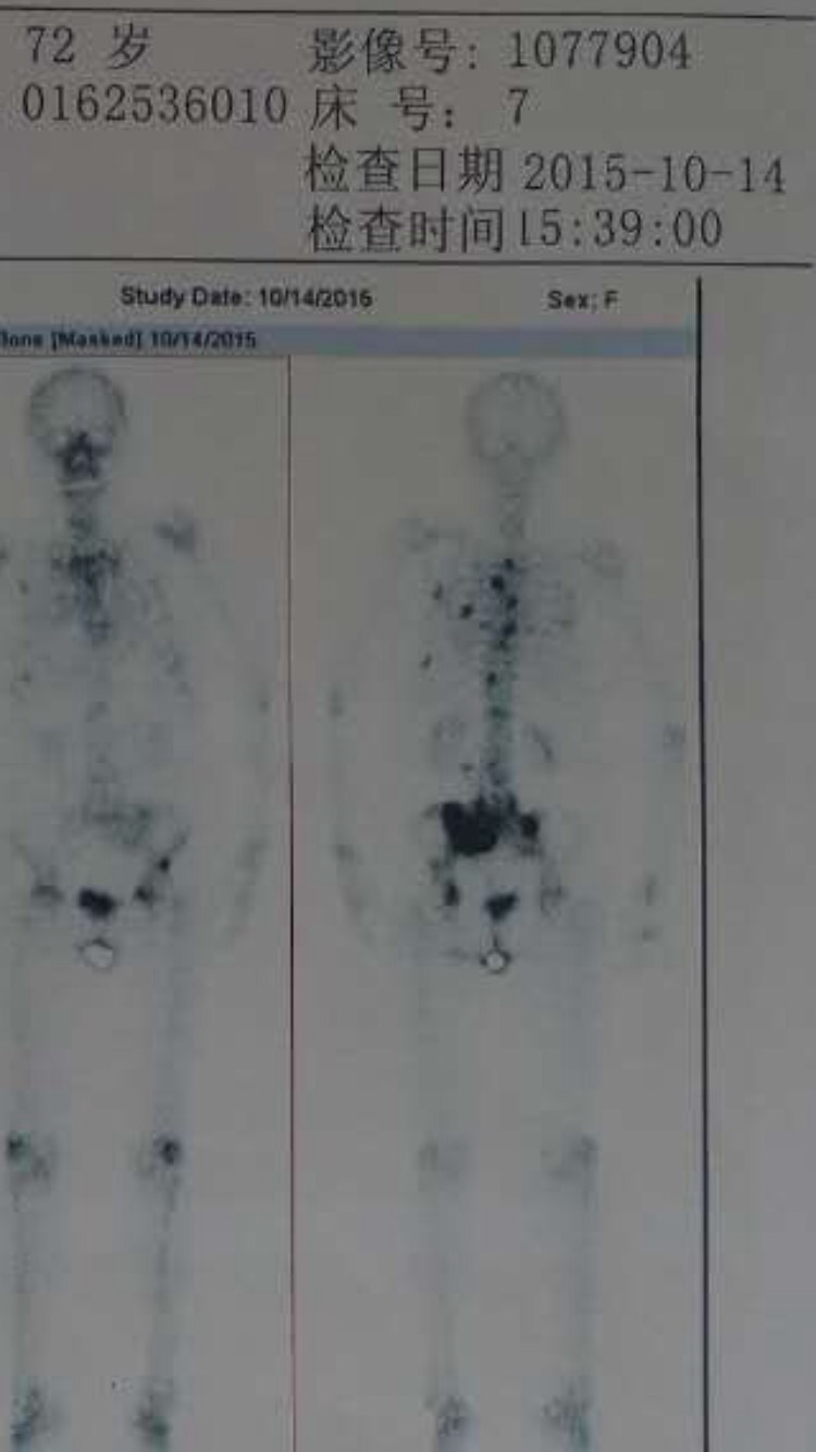 这是2015年10月的骨扫描
